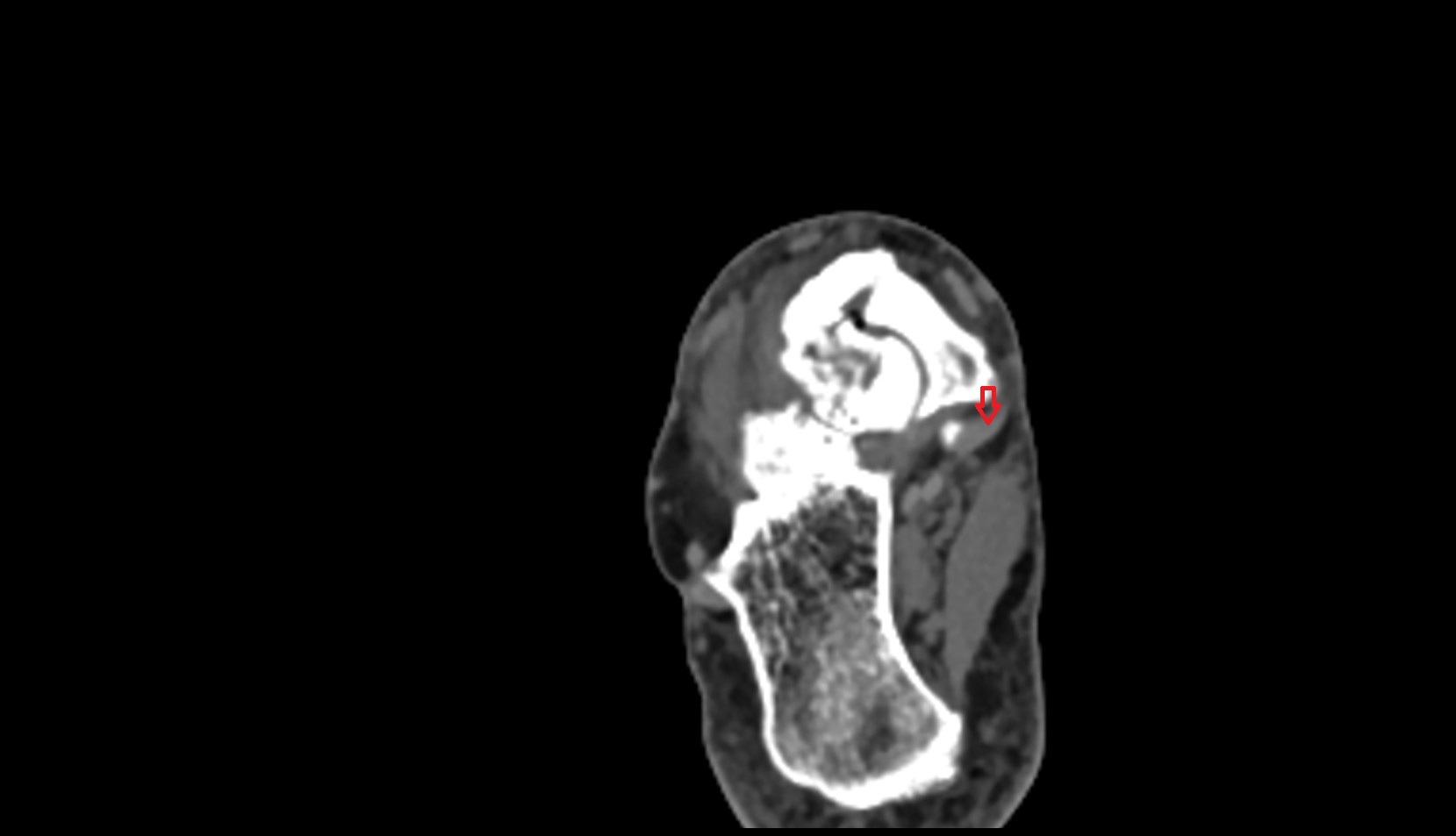 Tibialis posterior tendon ct axial image 3