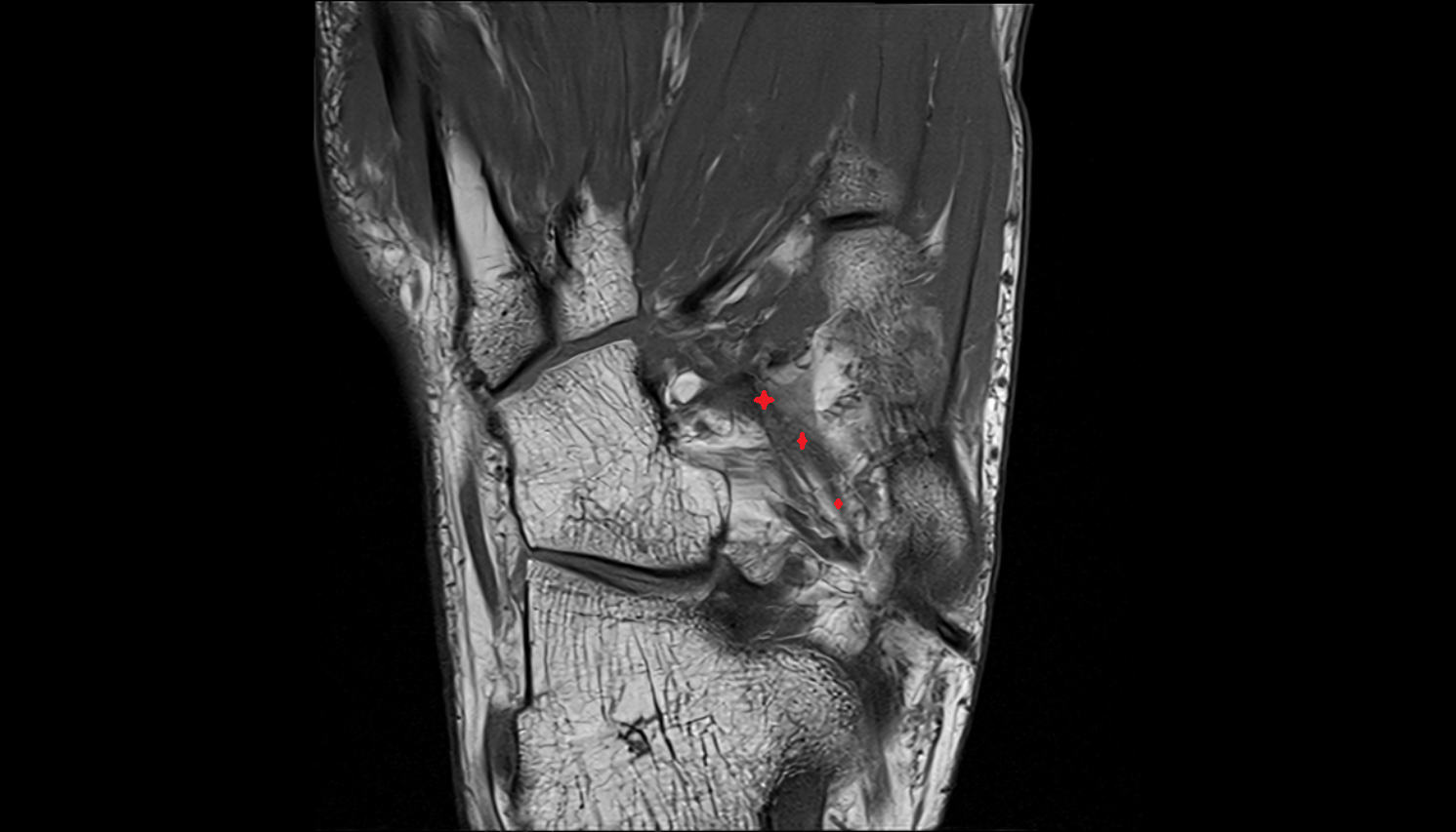 Tibialis posterior tendon (cuneiform insertions) axial cross sectional anatomy 3T MRI AI enhanced radiology image-img-00000-00000