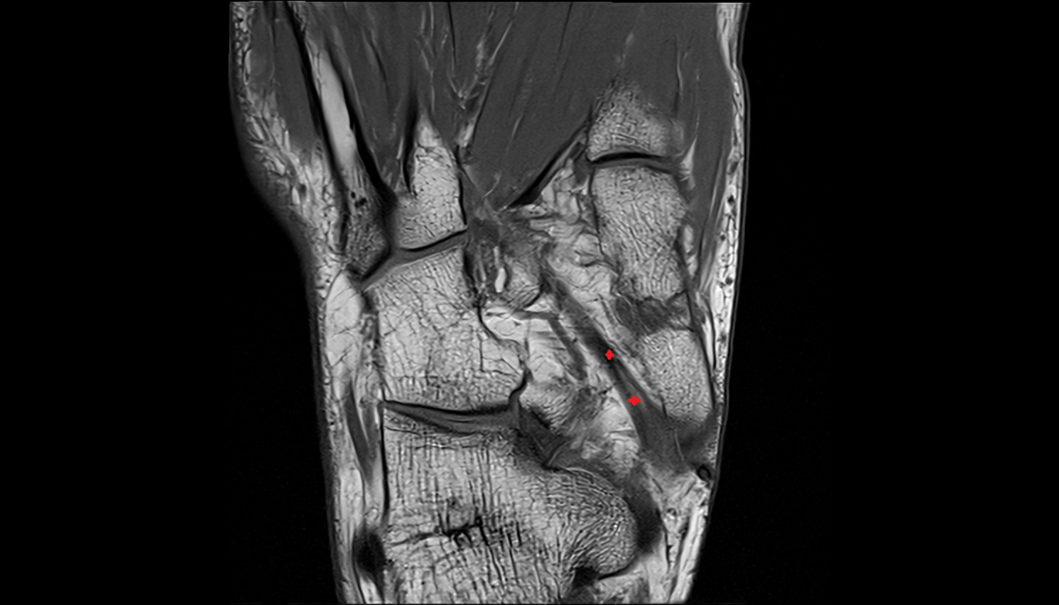 Tibialis posterior tendon (lateral slips) axial cross sectional anatomy 3T MRI AI enhanced radiology image-img-00000-00000
