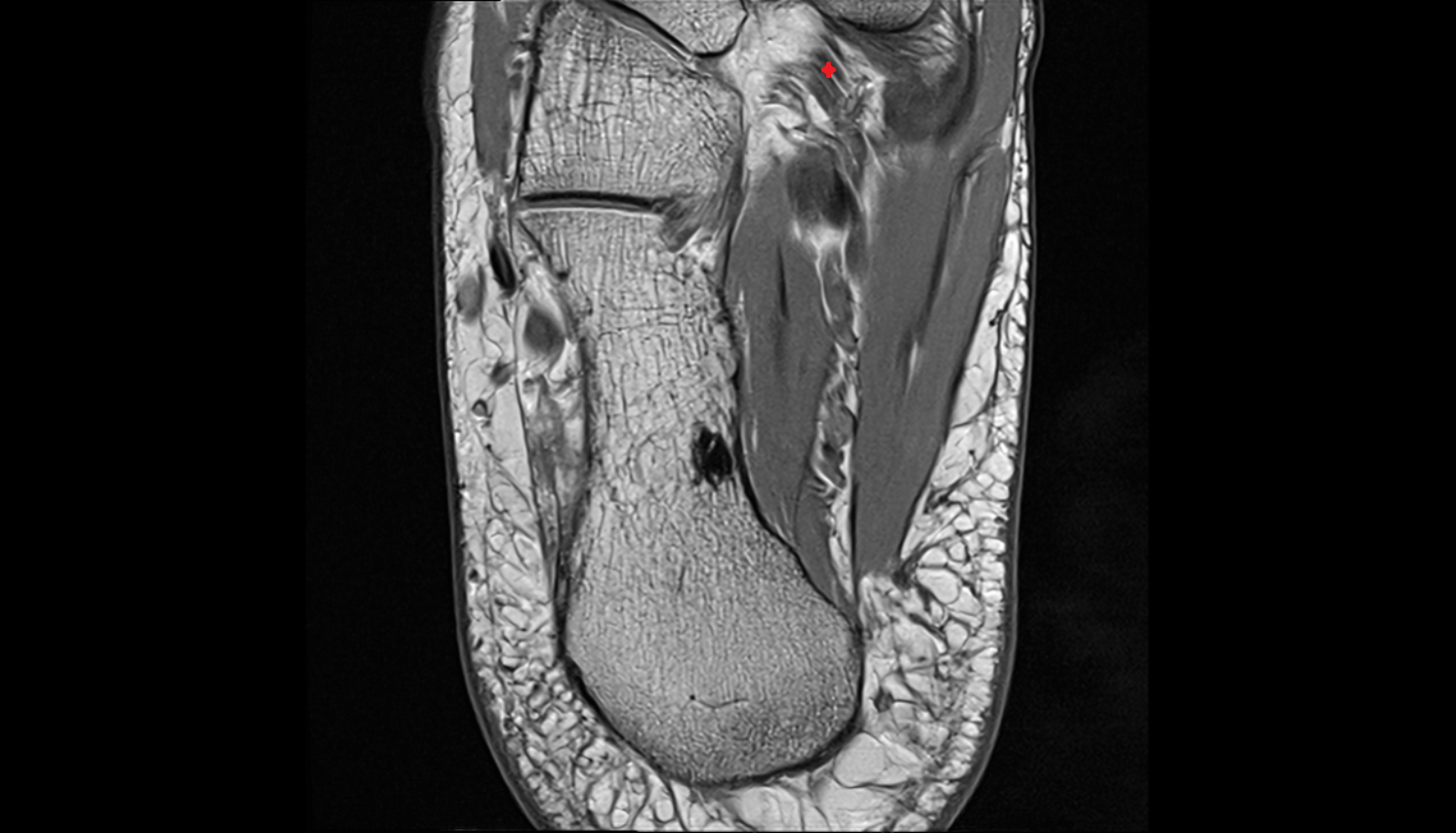 Tibialis posterior tendon (lateral slips) axial cross sectional anatomy 3T MRI AI enhanced radiology image-img-00000-00000_00001