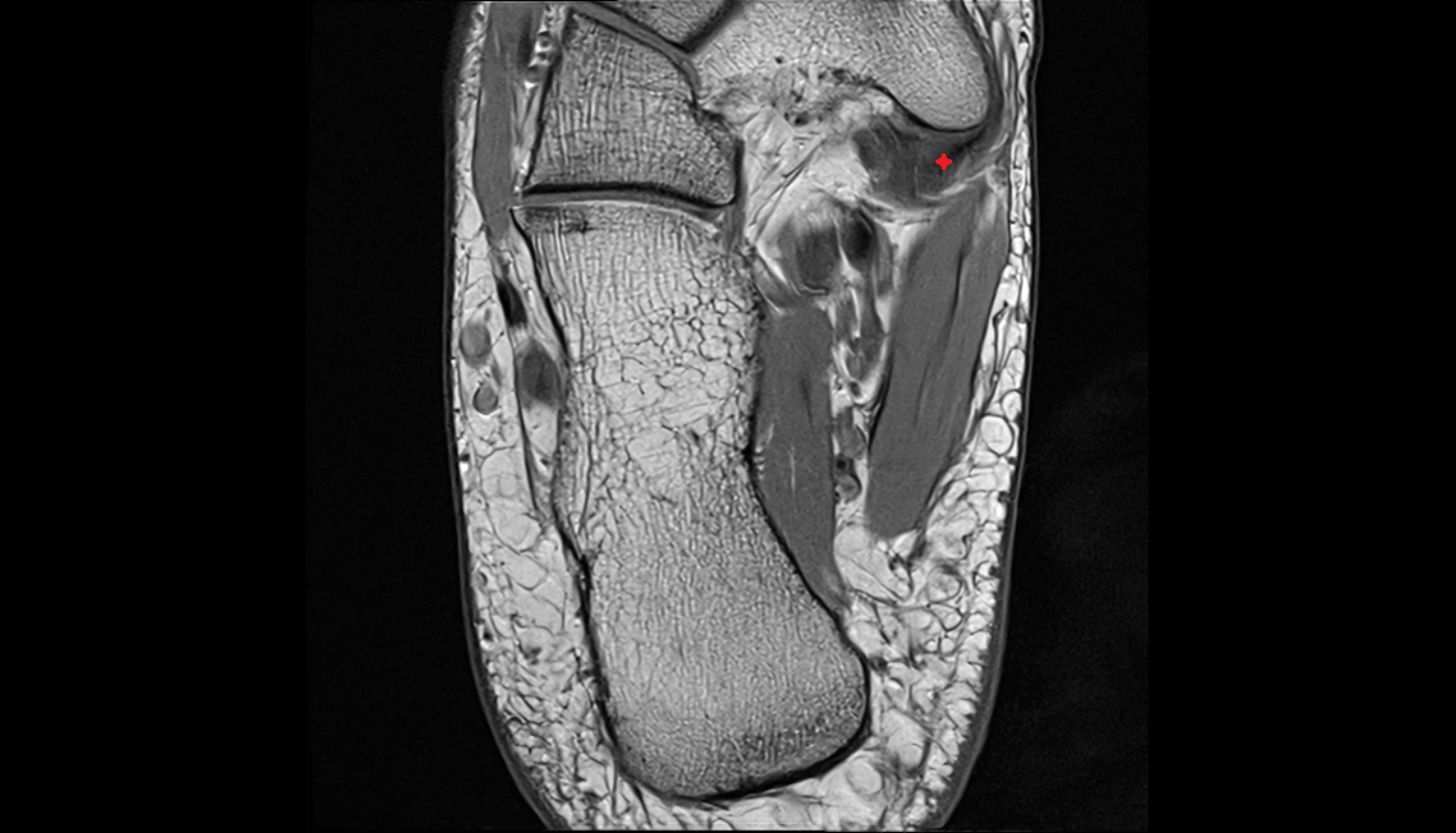 Tibialis posterior tendon (medial slip) axial cross sectional anatomy 3T MRI AI enhanced radiology image-img-00000-00000_00001