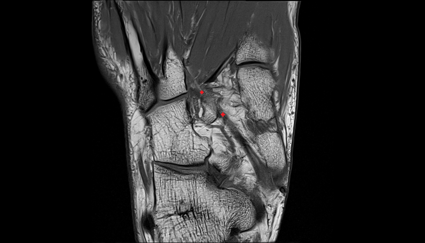 Tibialis posterior tendon (metatarsal insertions)  axial cross sectional anatomy 3T MRI AI enhanced radiology image-img-00000-00000
