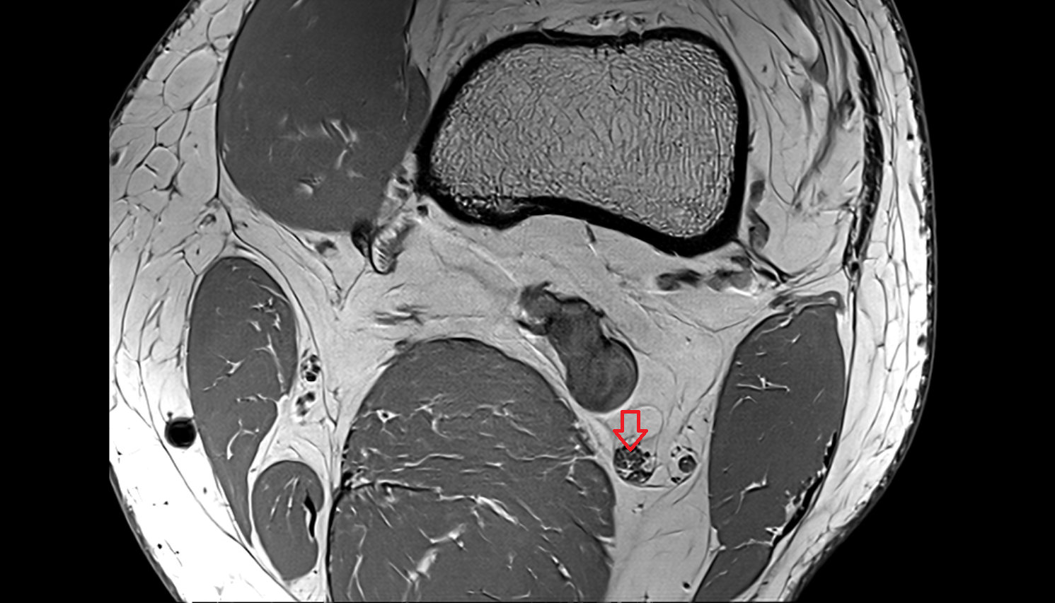 Tibial nerve axial  cross sectional anatomy 3T MRI AI enhanced  radiology  anatomy image-img-00000-00000