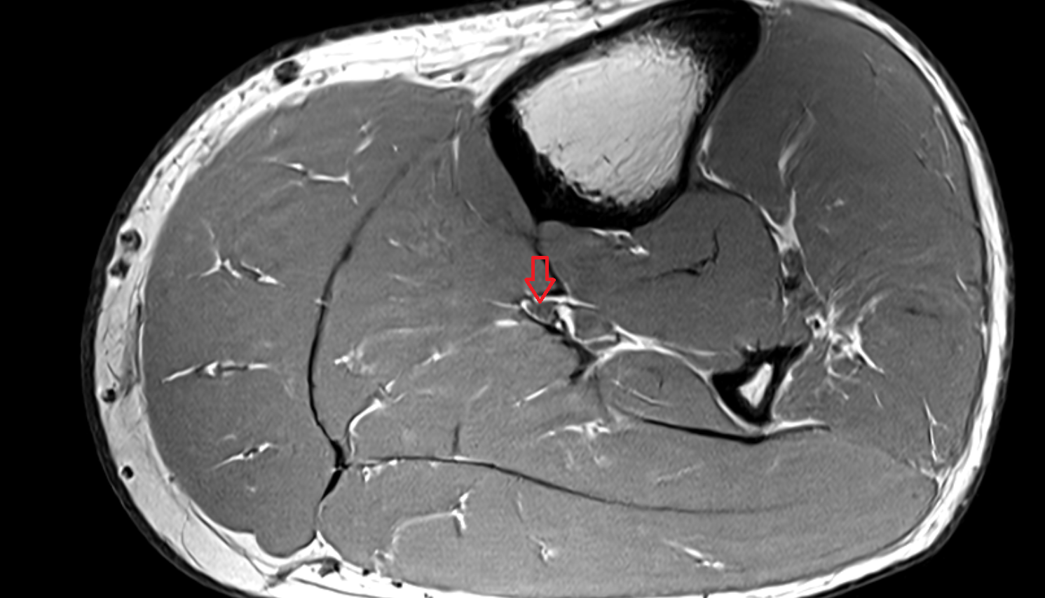 Tibial nerve  axial cross sectional anatomy 3T MRI AI enhanced radiology image-img-00000-00000