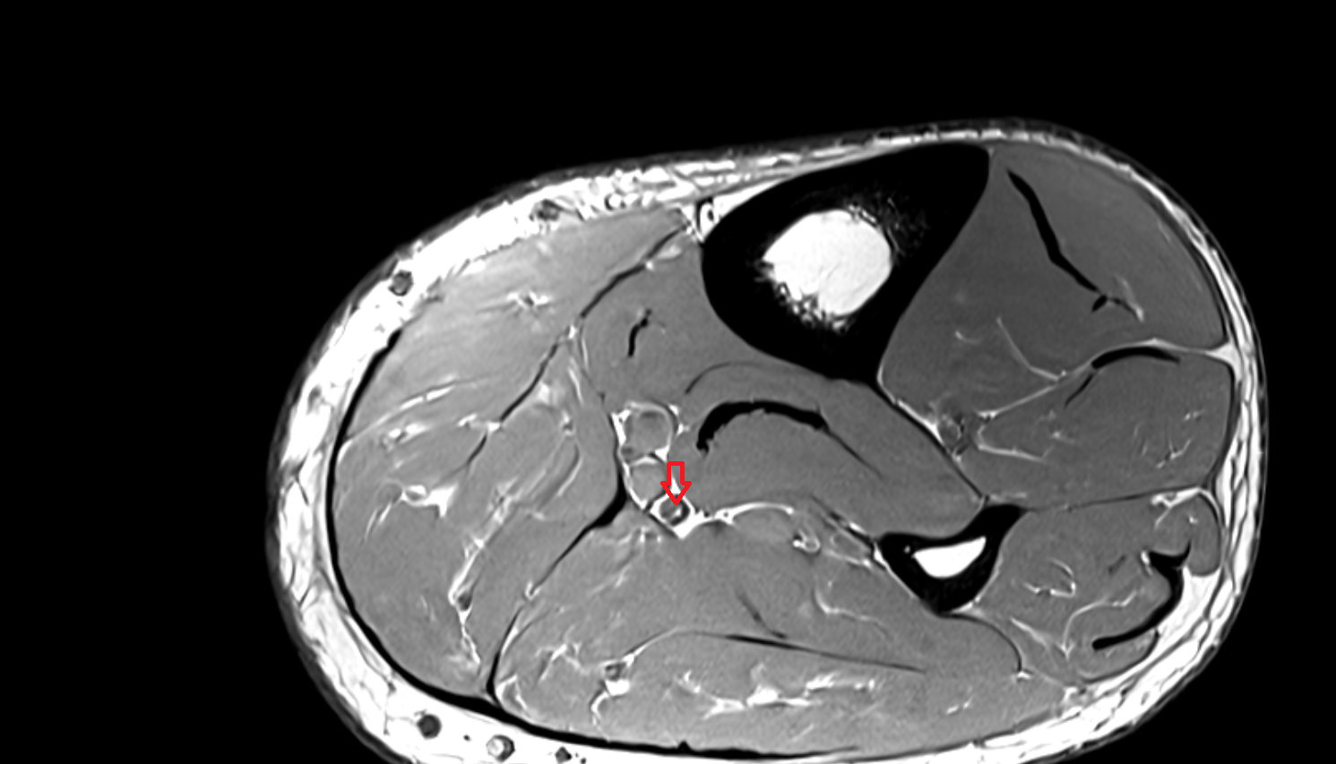 Tibial nerve  axial cross sectional anatomy 3T MRI AI enhanced radiology image-img-00000-00000_00001