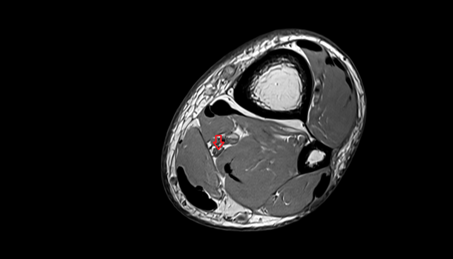 Tibial nerve  axial cross sectional anatomy 3T MRI AI enhanced radiology image-img-00000-00000_00002