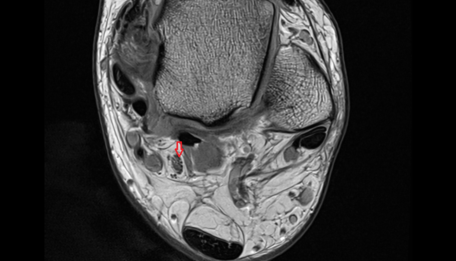 Tibial nerve  axial cross sectional anatomy 3T MRI AI enhanced radiology image-img-00000-00000_00004