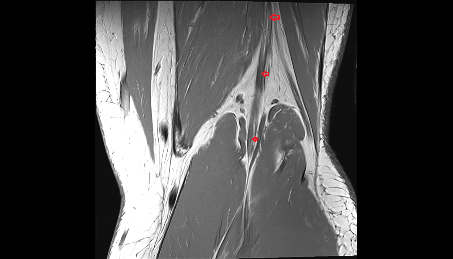 Tibial nerve coronal  cross sectional anatomy 3T MRI AI enhanced  radiology  anatomy image-img-00000-00000