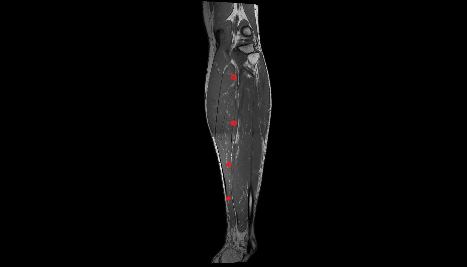 Tibial nerve coronal cross sectional anatomy 3T MRI AI enhanced radiology image-img-00000-00000