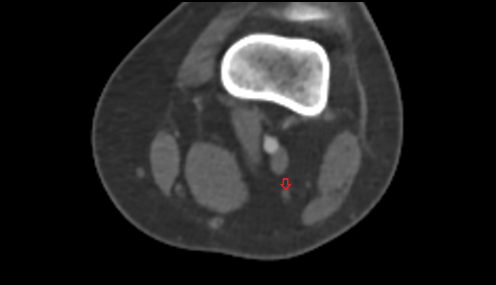 Tibial nerve ct axial