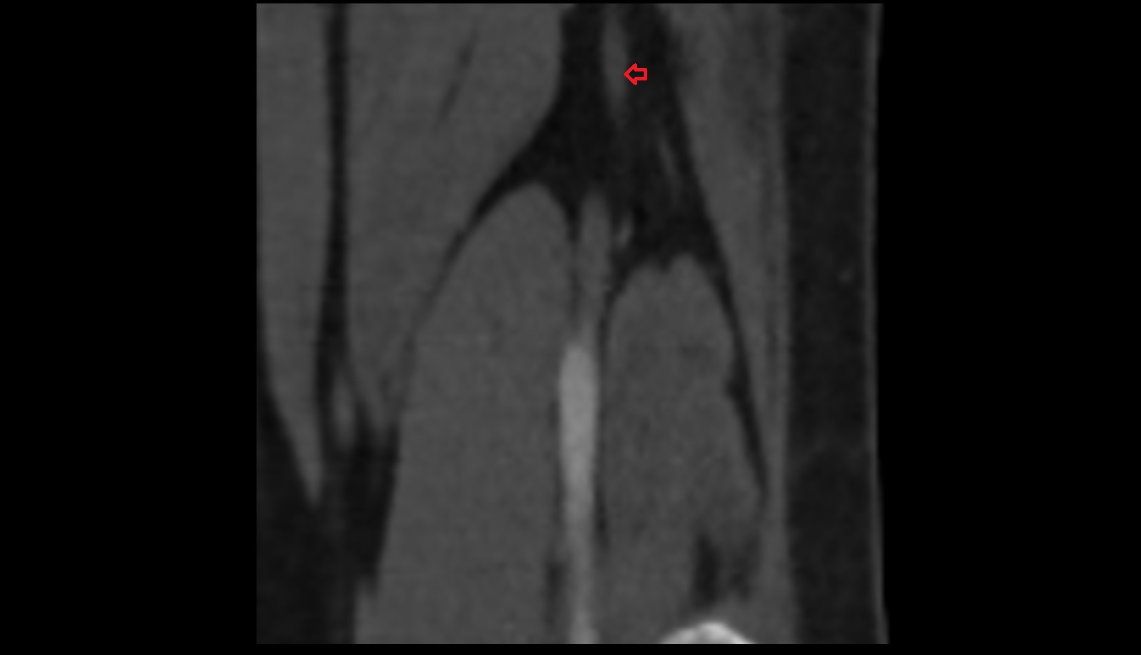 Tibial nerve ct coronal image