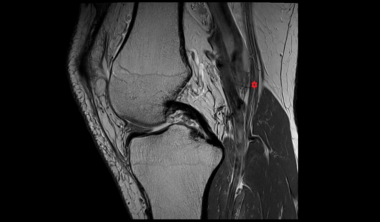 Tibial nerve mri image
