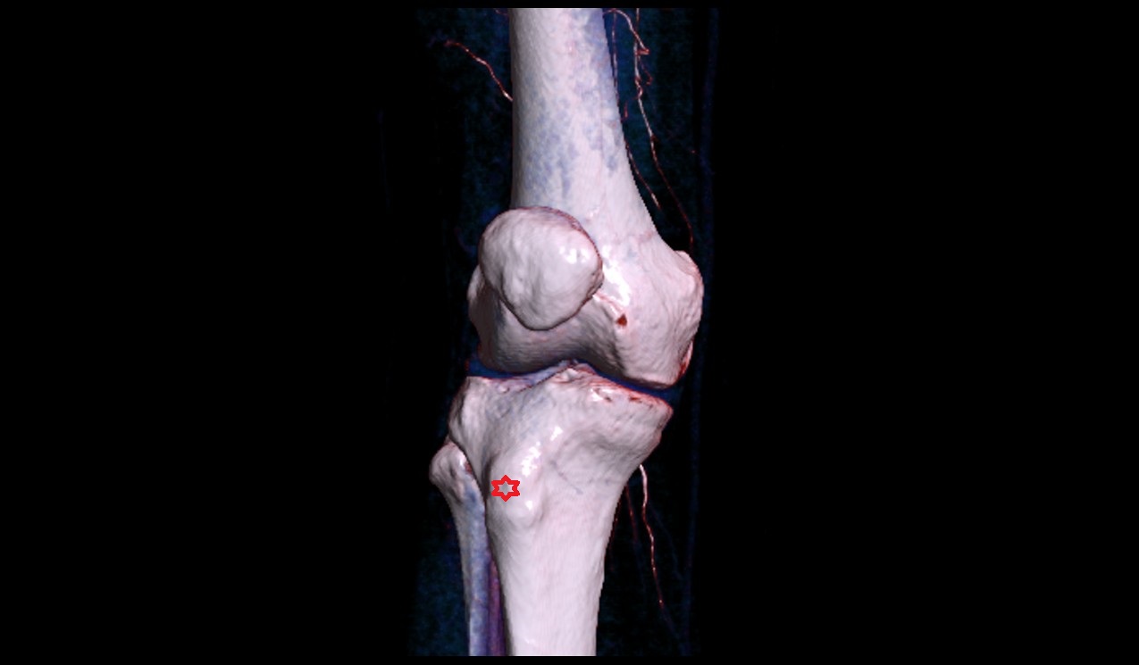 Tibial tuberosity 3d image