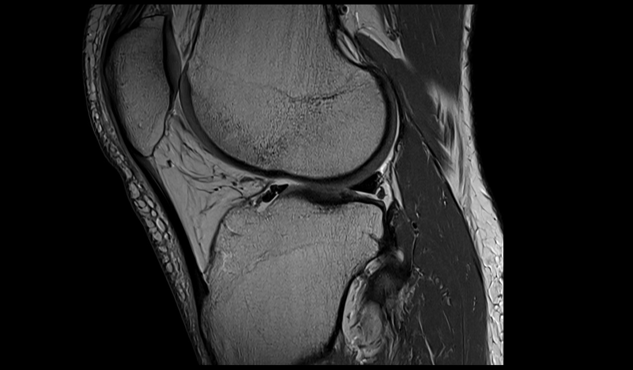 Tibial tuberosity anatomy