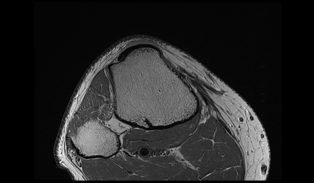 Tibial tuberosity anatomy mri 3t