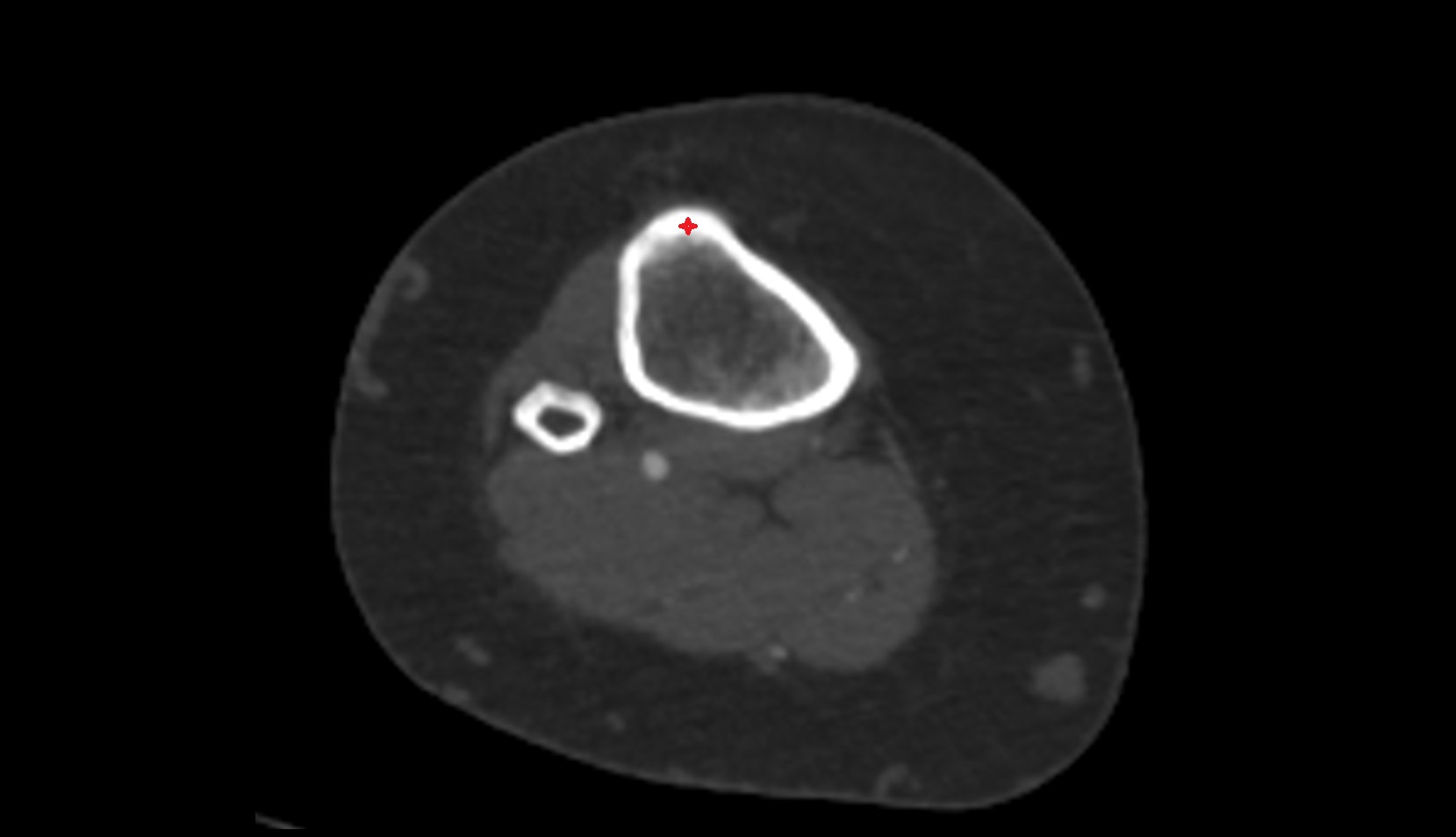Tibial tuberosity ct axial image