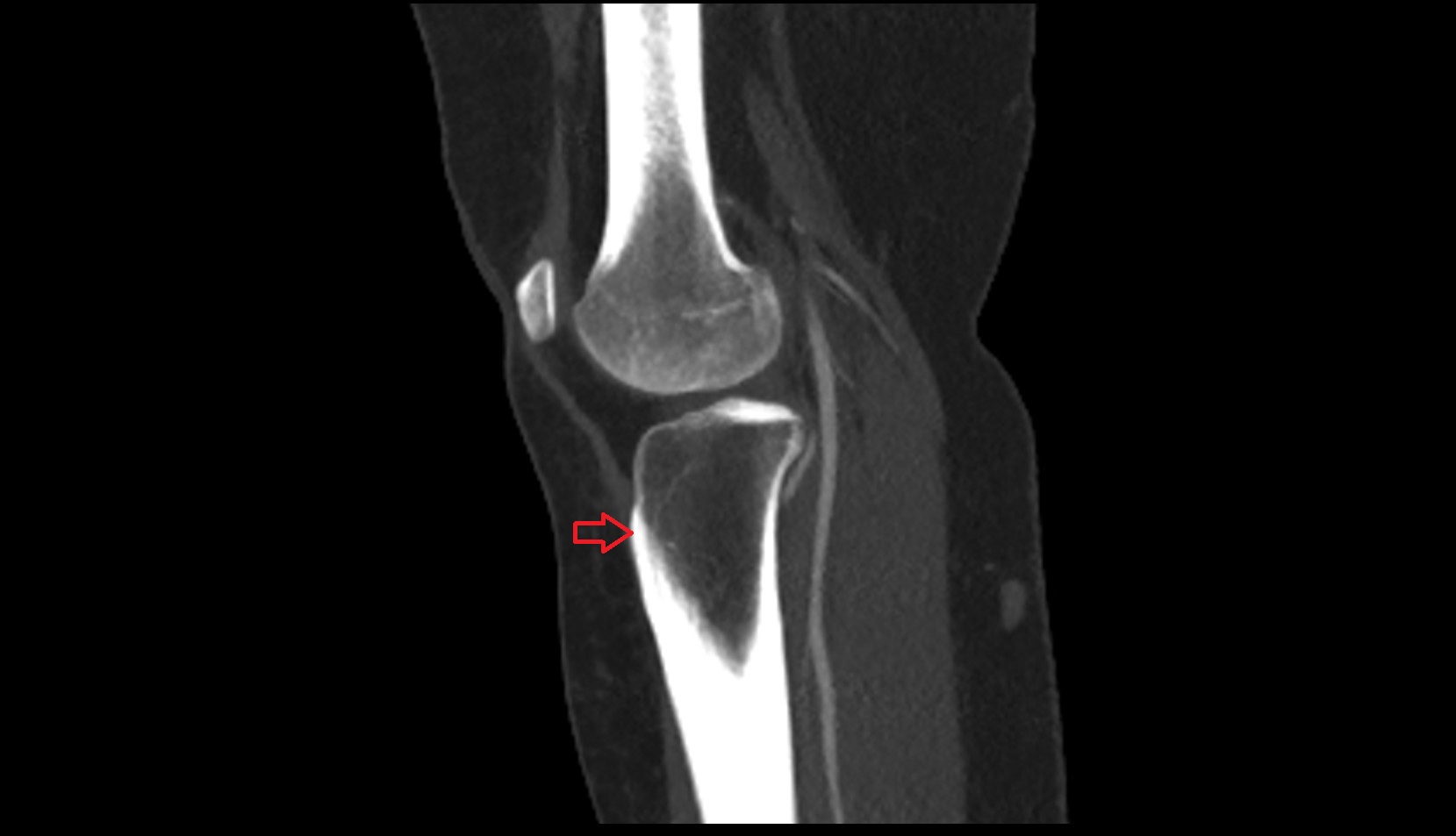 Tibial tuberosity ct sagittal image