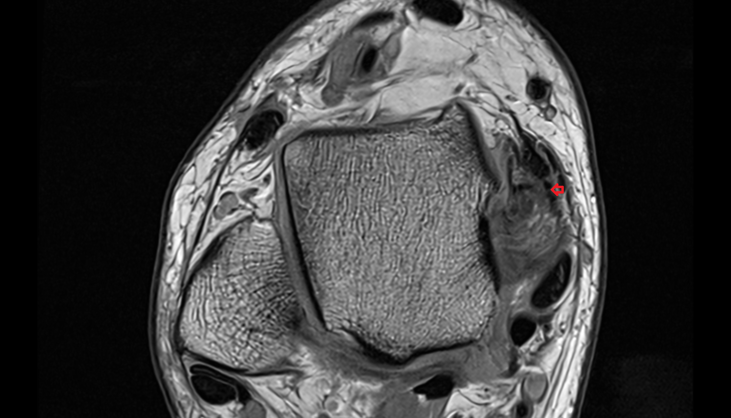 Tibiocalcaneal ligament (Superficial deltoid)  axial cross sectional anatomy 3T MRI AI enhanced radiology image-img-00000-00000