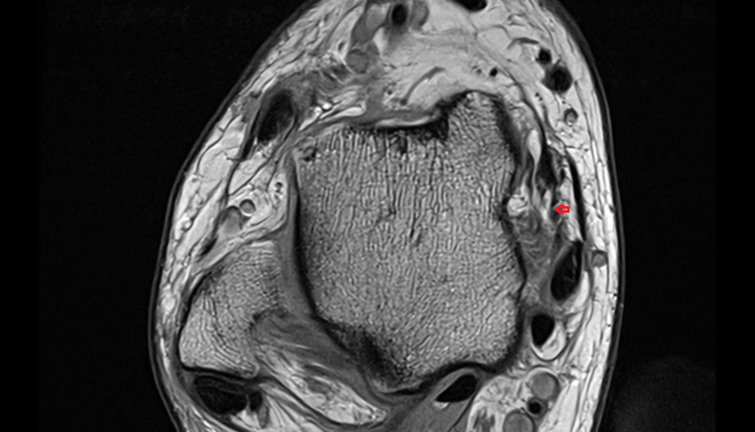 Tibiocalcaneal ligament (Superficial deltoid)  axial cross sectional anatomy 3T MRI AI enhanced radiology image-img-00000-00000_00001