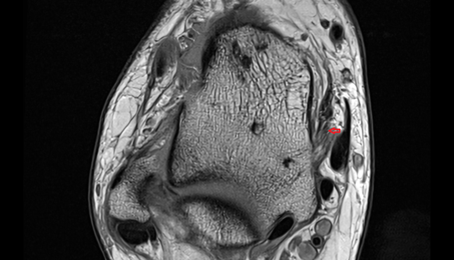 Tibiocalcaneal ligament (Superficial deltoid)  axial cross sectional anatomy 3T MRI AI enhanced radiology image-img-00000-00000_00002