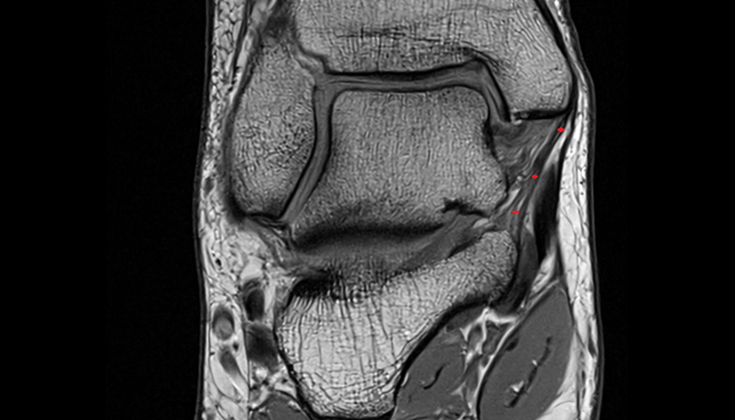 Tibiocalcaneal ligament (Superficial deltoid)  coronal cross sectional anatomy 3T MRI AI enhanced radiology image-img-00000-00000