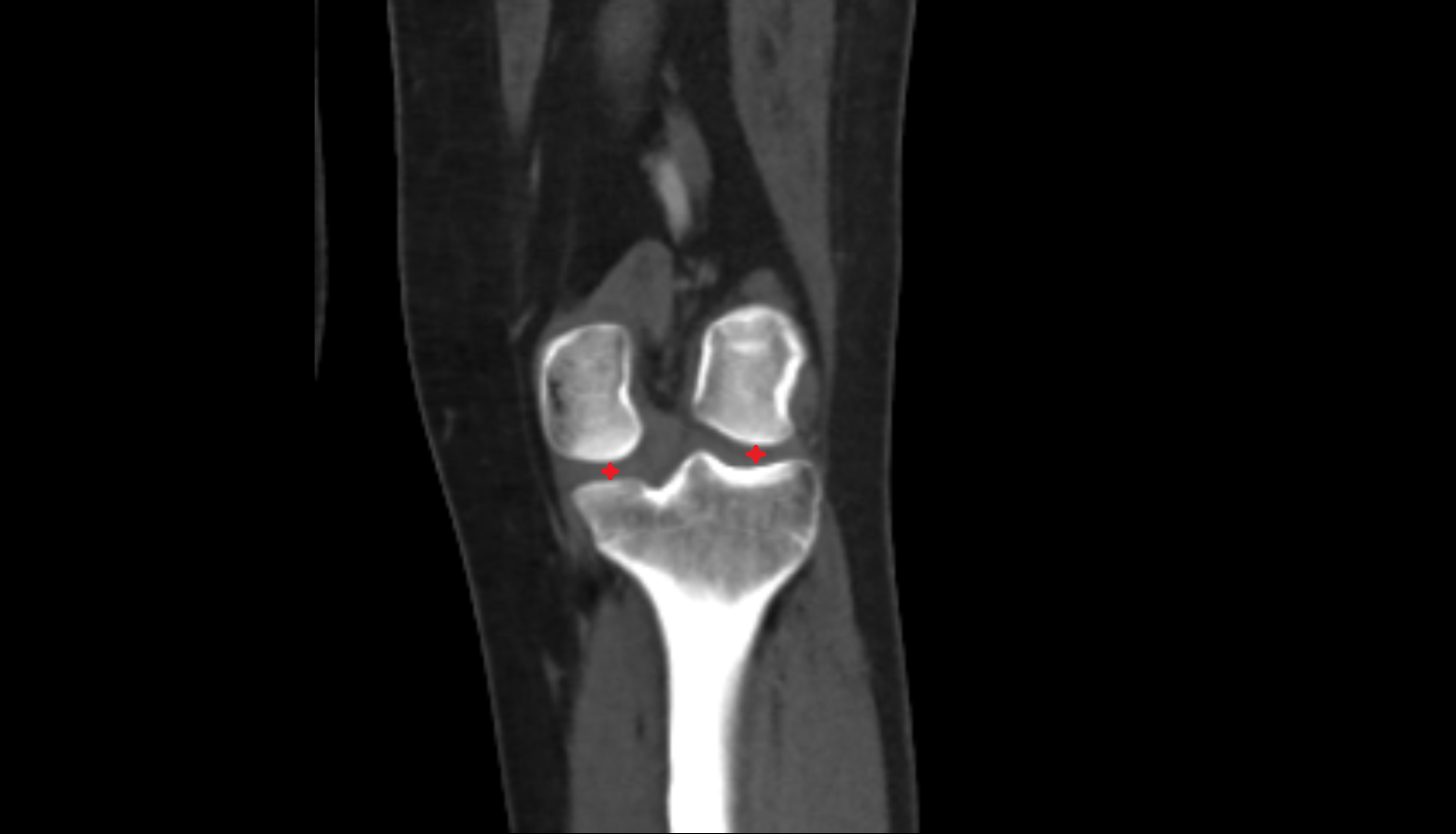 Tibiofemoral joint space  ct  anatomy labelled image-img-00000-00000