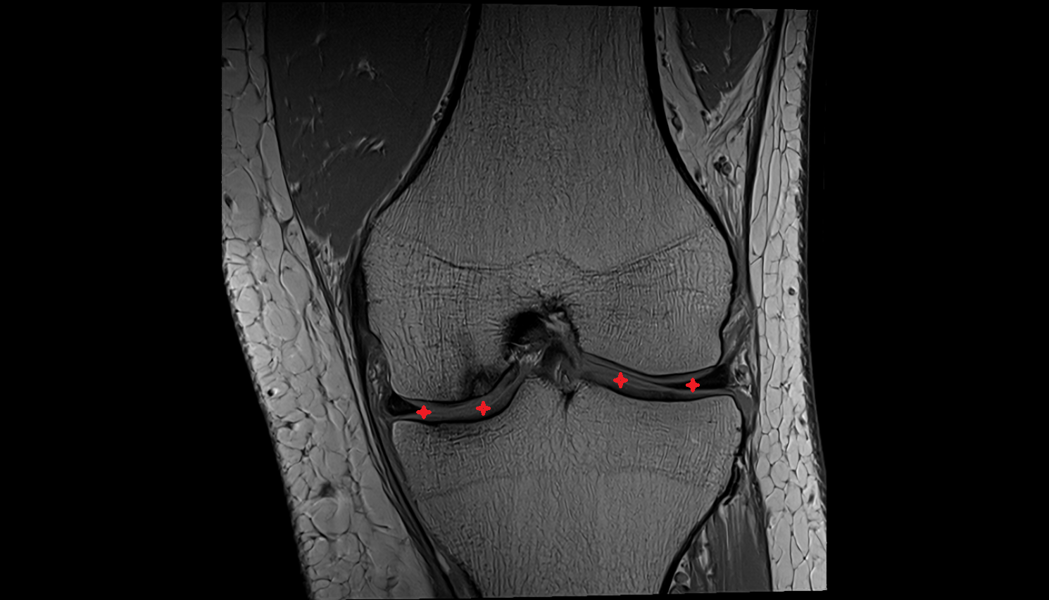 Tibiofemoral joint space  mri  anatomy labelled image-img-00000-00000