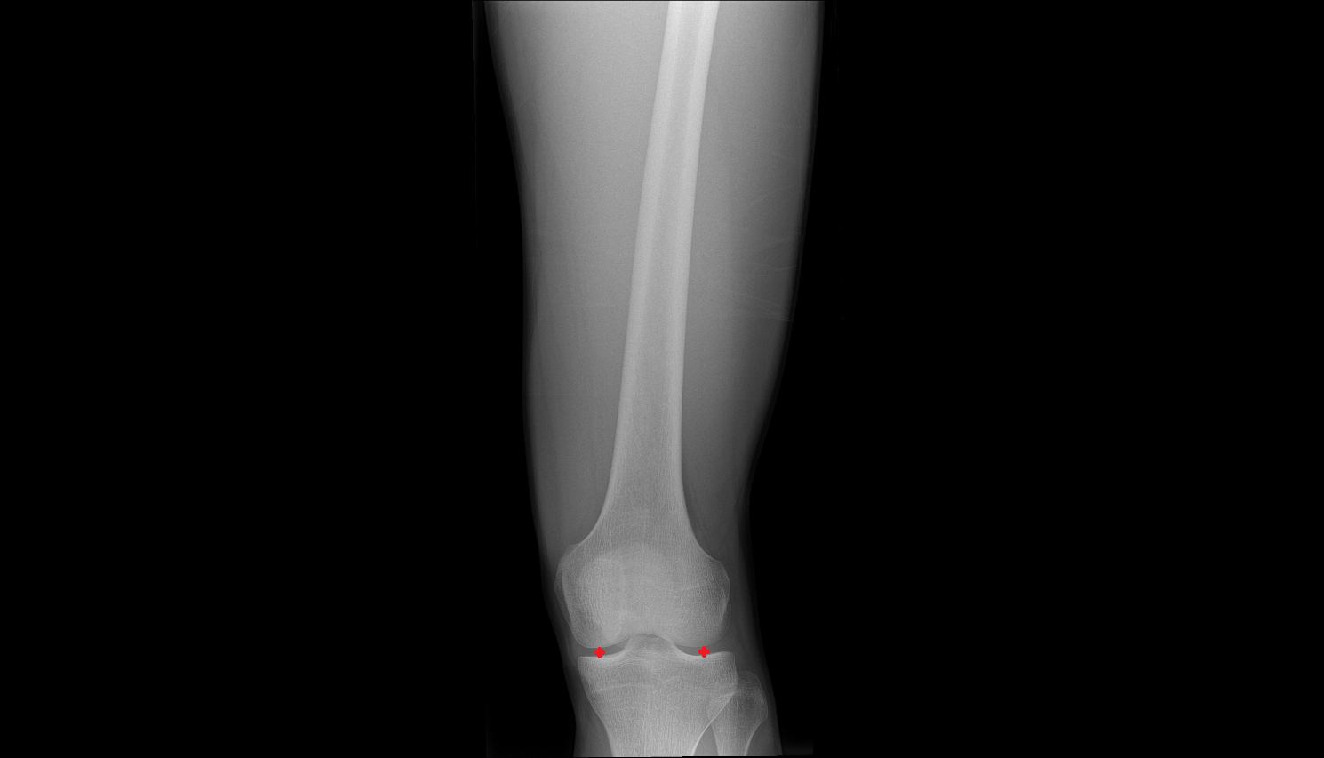 Tibiofemoral joint space  mri  anatomy labelled image-img-00000-00000_00001