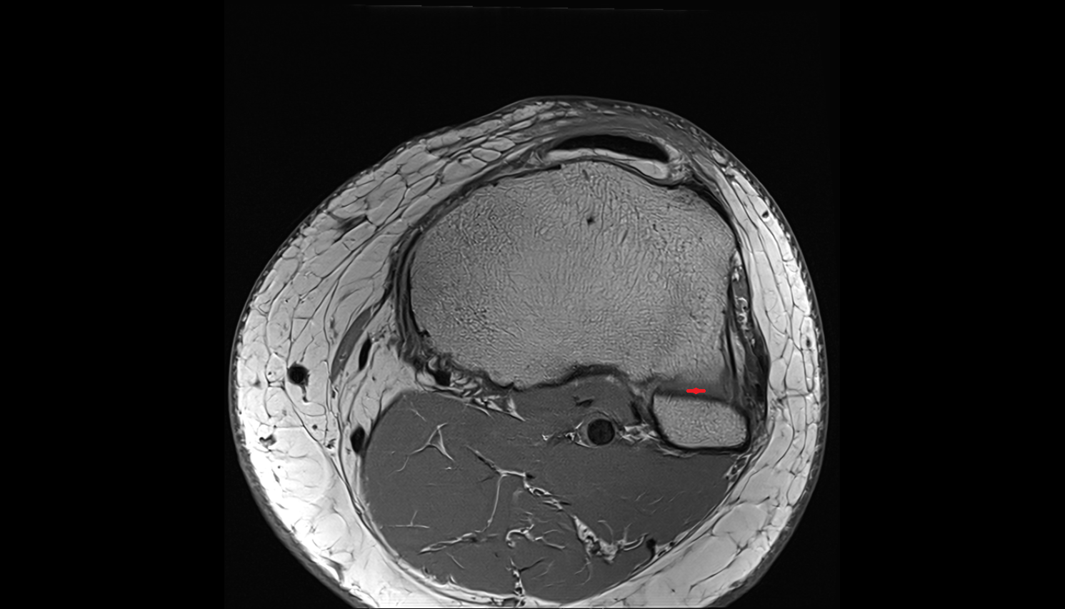 Tibiofibular joint (proximal) axial  cross sectional anatomy 3T MRI AI enhanced  radiology  anatomy image-img-00000-00000