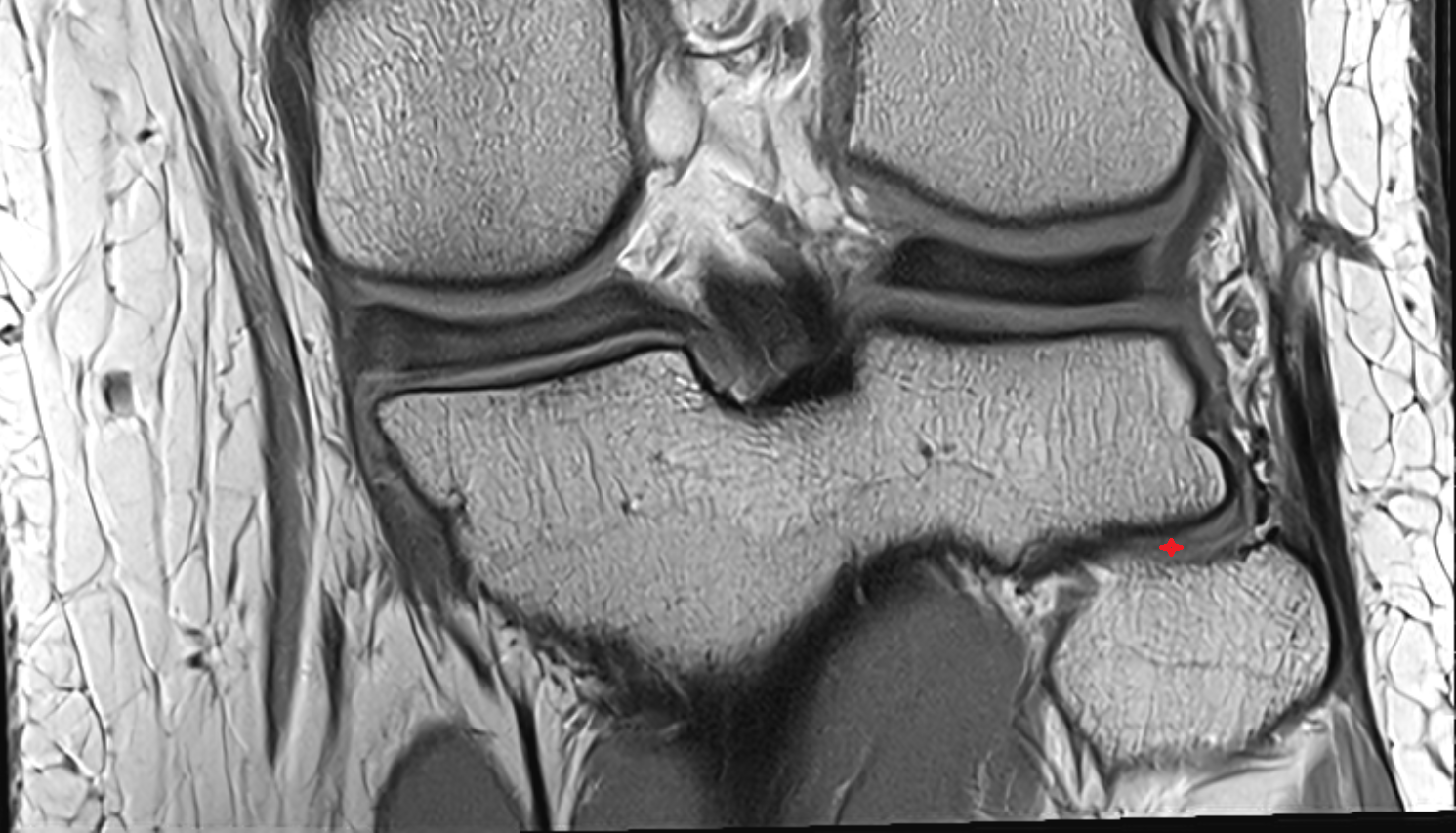 Tibiofibular joint (proximal)  coronal  cross sectional anatomy 3T MRI AI enhanced  radiology  anatomy image-img-00000-00000