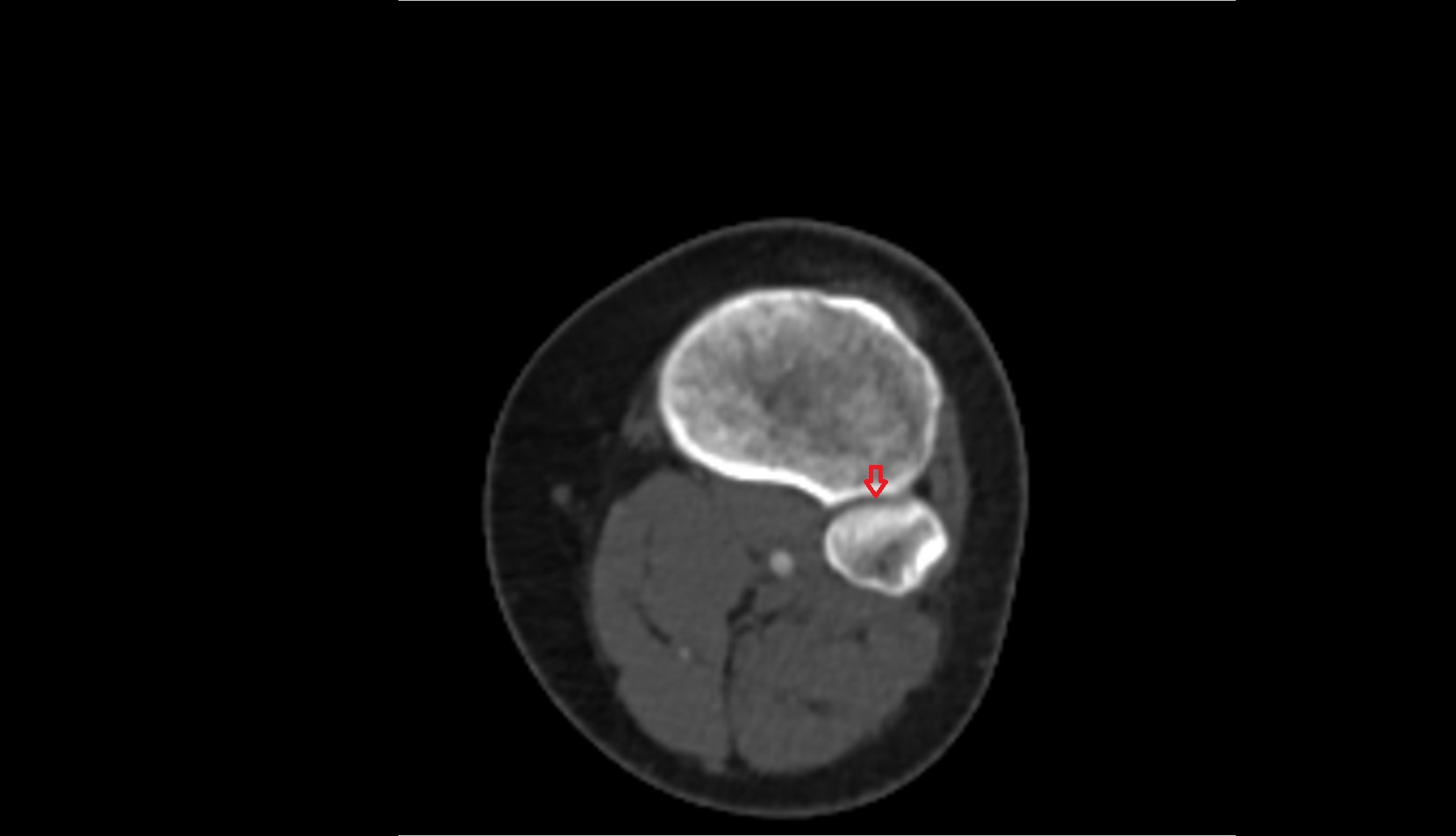 Tibiofibular joint (proximal) ct axial