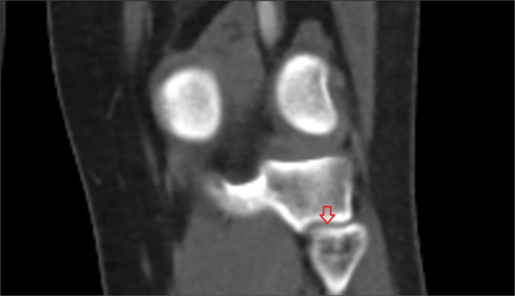 Tibiofibular joint (proximal) ct coronal