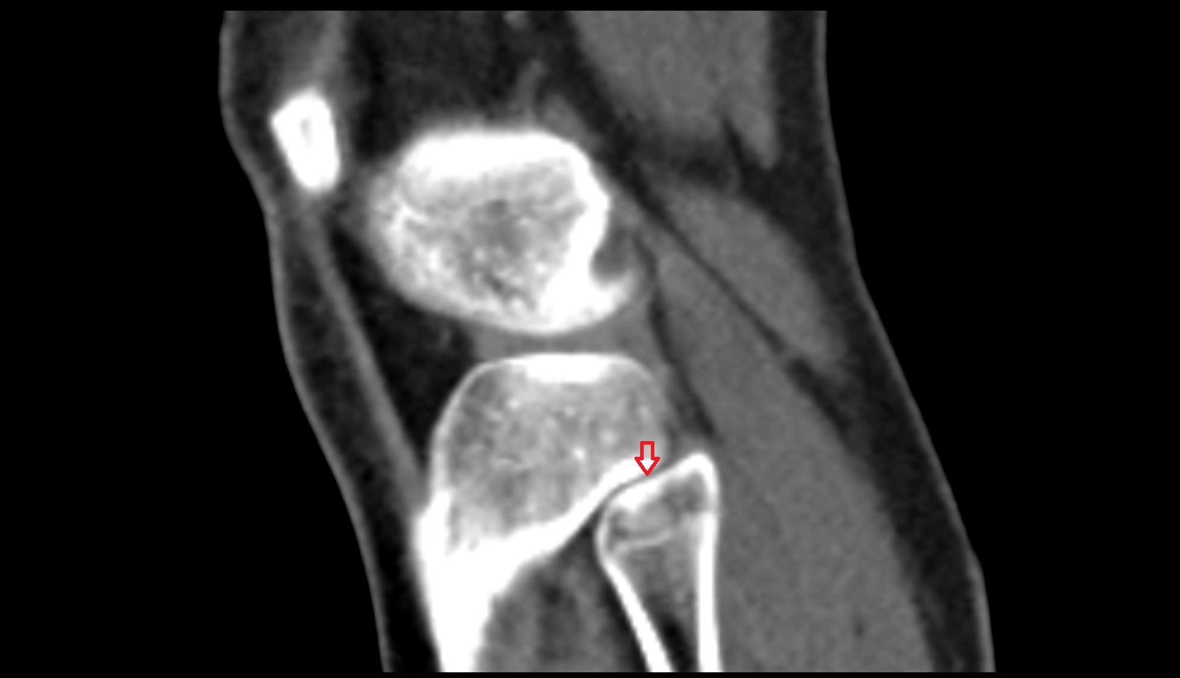 Tibiofibular joint (proximal) ct sag