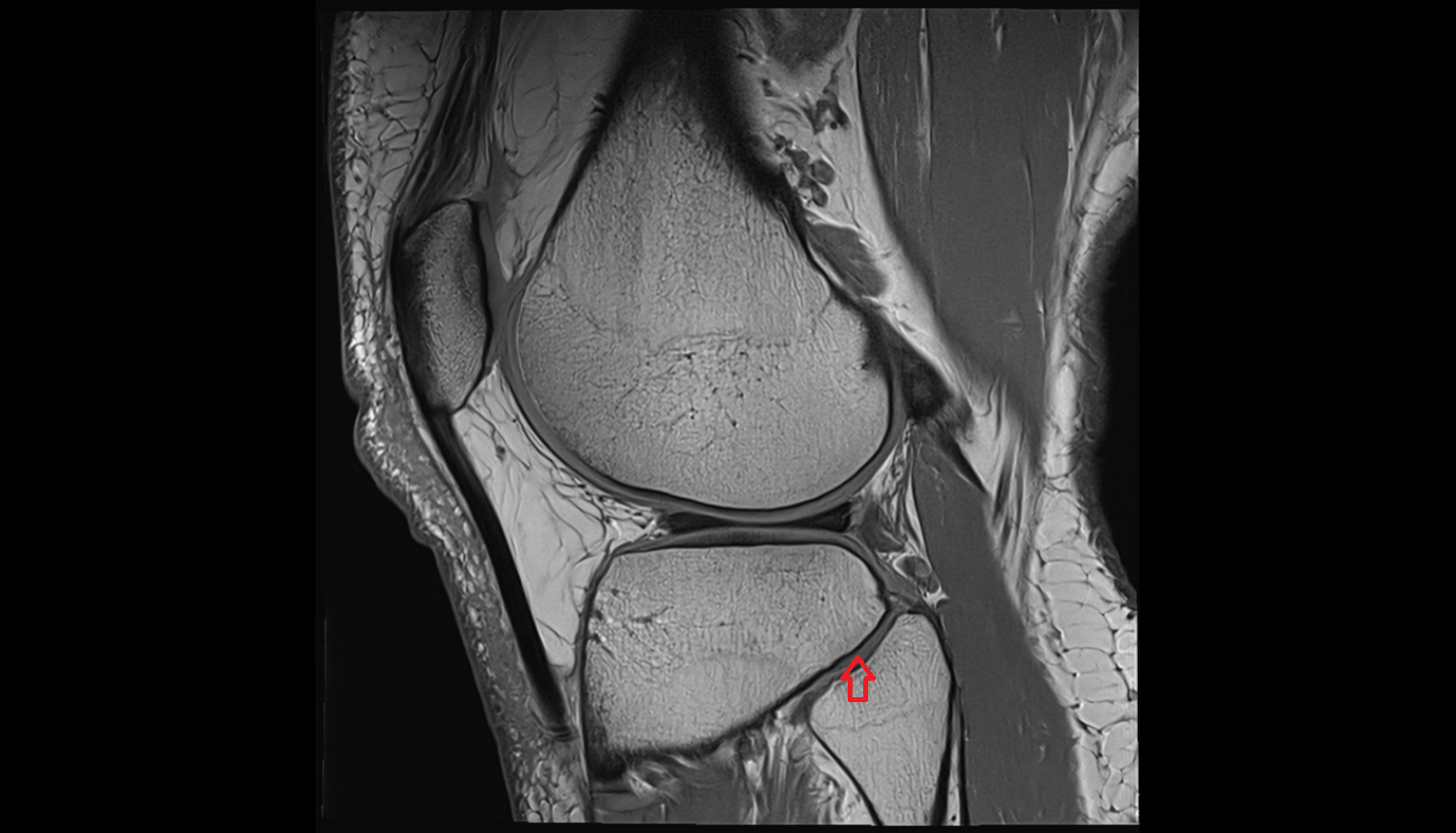 Tibiofibular joint (proximal) sagittal  cross sectional anatomy 3T MRI AI enhanced  radiology  anatomy image-img-00000-00000