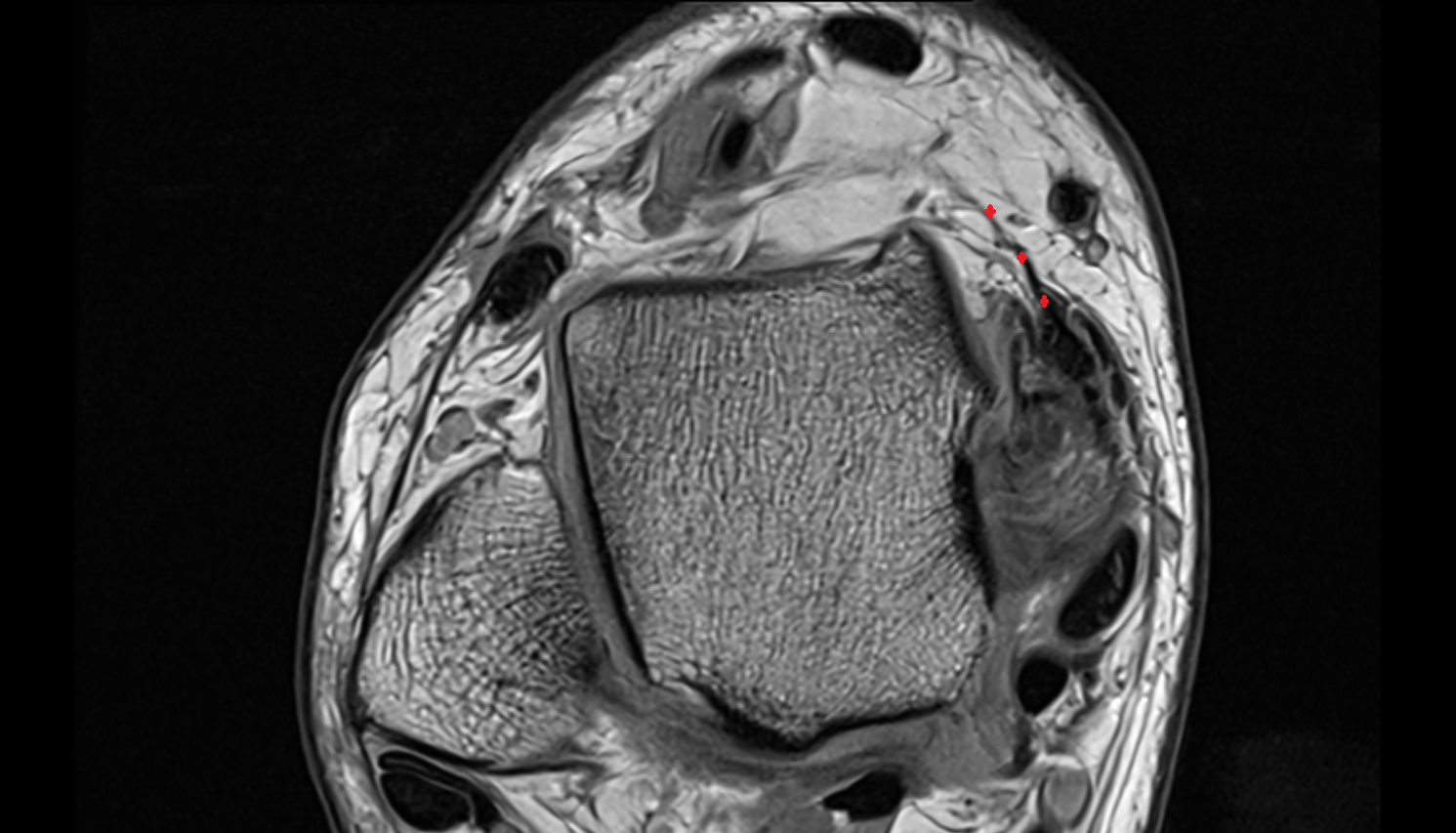 Tibionavicular ligament (Superficial deltoid) axial cross sectional anatomy 3T MRI AI enhanced radiology image-img-00000-00000