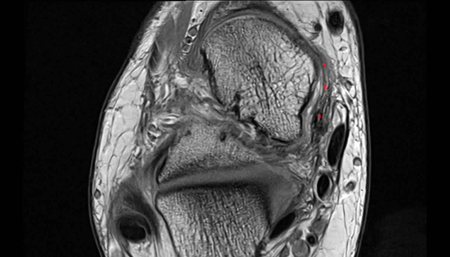 Tibionavicular ligament (Superficial deltoid) axial cross sectional anatomy 3T MRI AI enhanced radiology image-img-00000-00000_00001