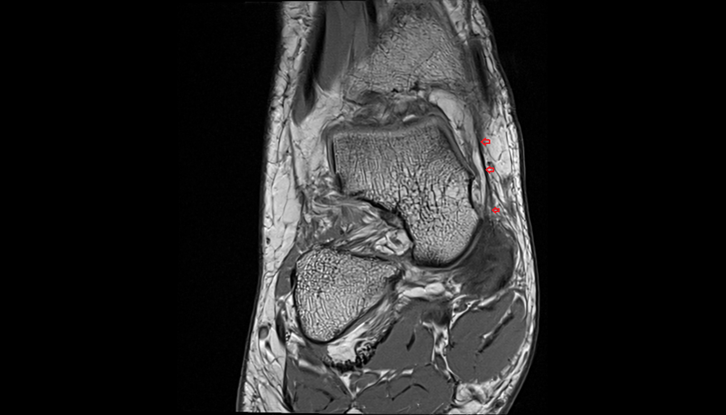 Tibionavicular ligament (Superficial deltoid) coronal cross sectional anatomy 3T MRI AI enhanced radiology image-img-00000-00000_00002