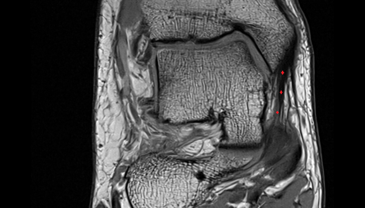 Tibiospring Ligament (Superficial Deltoid)  coronal cross sectional anatomy 3T MRI AI enhanced radiology image-img-00000-00000