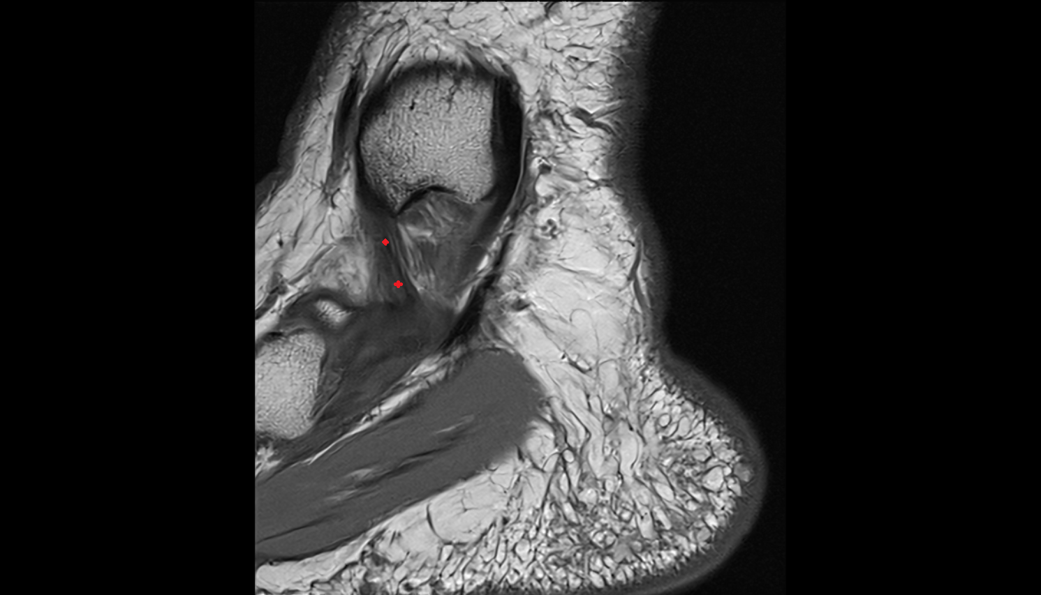 Tibiospring Ligament (Superficial Deltoid)  sag cross sectional anatomy 3T MRI AI enhanced radiology image-img-00000-00000