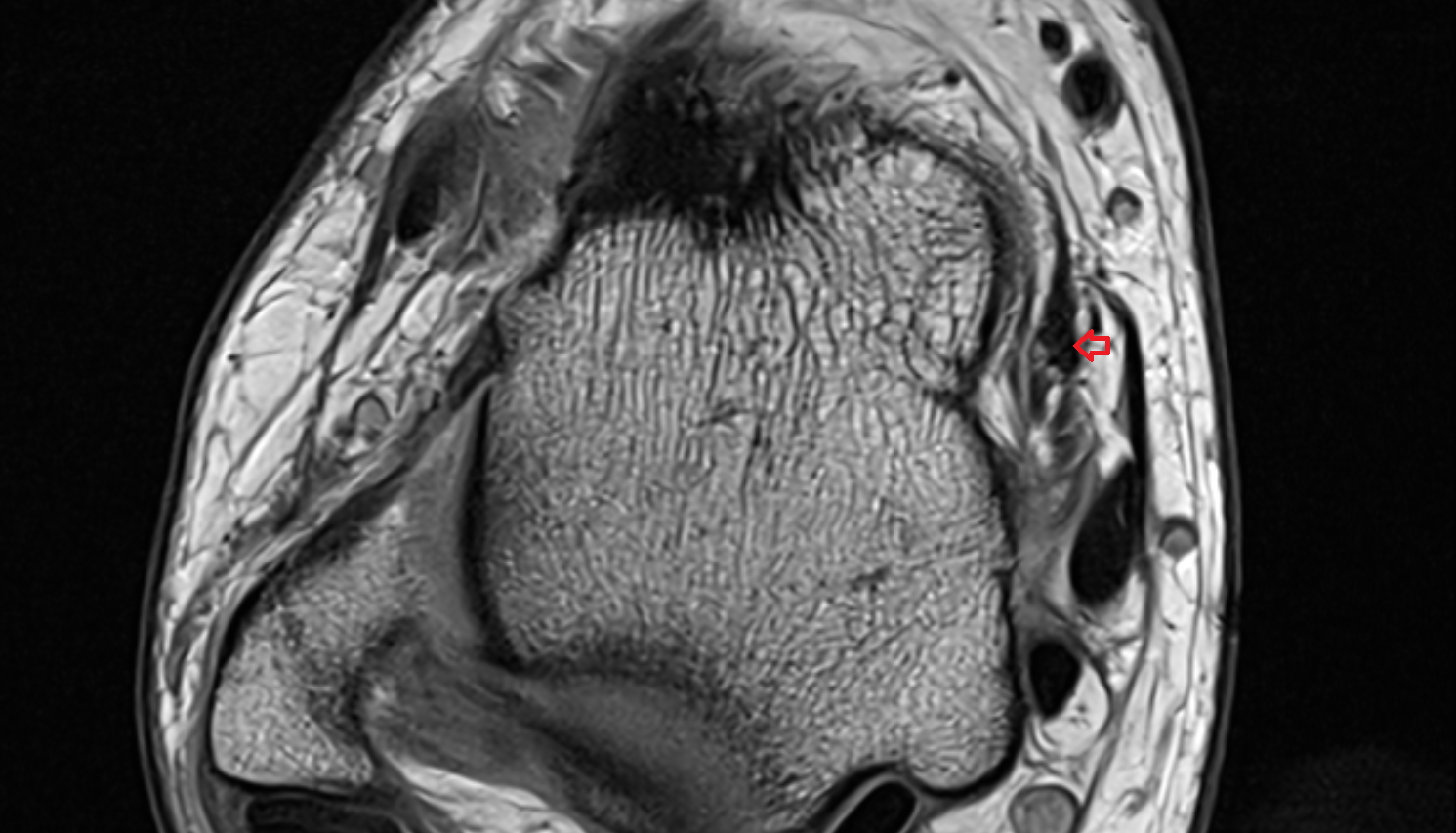 Tibiospring Ligament (Superficial Deltoid)  sag cross sectional anatomy 3T MRI AI enhanced radiology image-img-00000-00000_00001