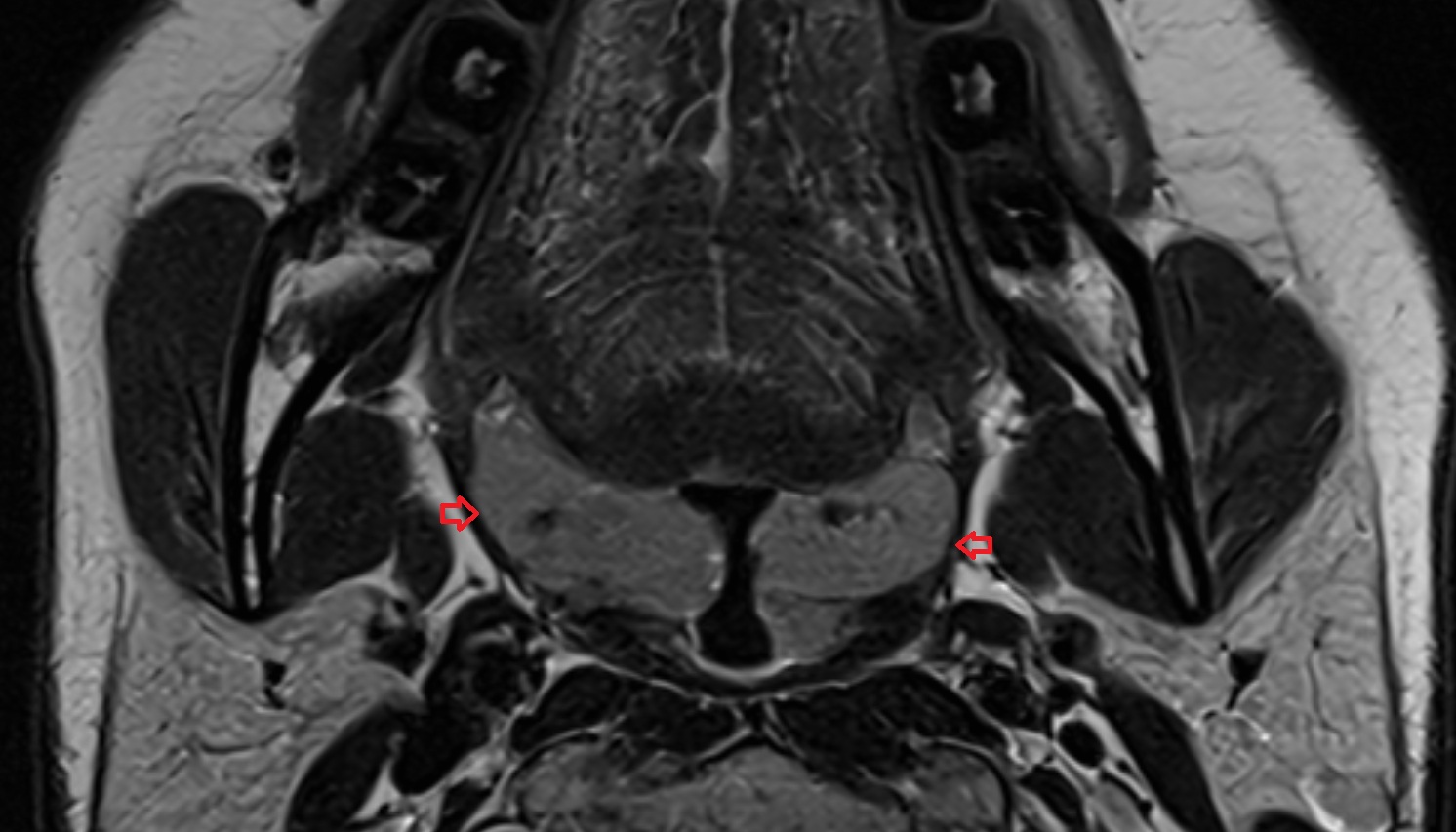 Tonsillar fossa mri axial image -img-00000-00000