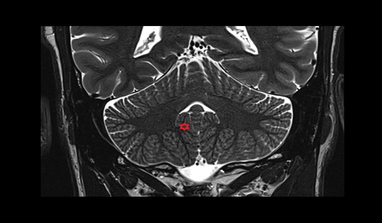 Tonsil of cerebellum MRI 3T coronal  image