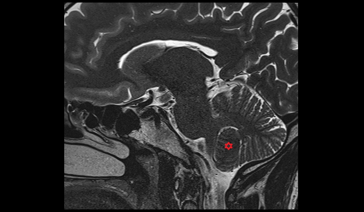 Tonsil of cerebellum MRI 3T sagittal image
