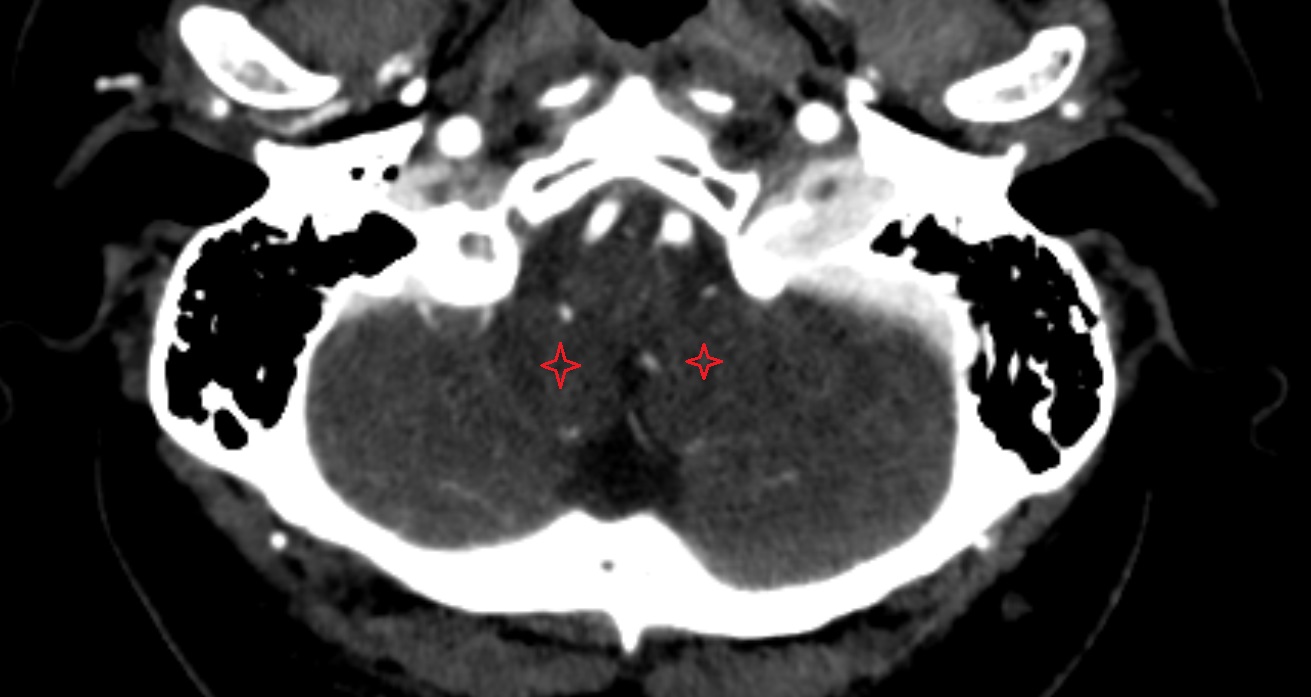 Tonsil of cerebellum of cerebellum  CT axial anatomy image -img-00001-00001