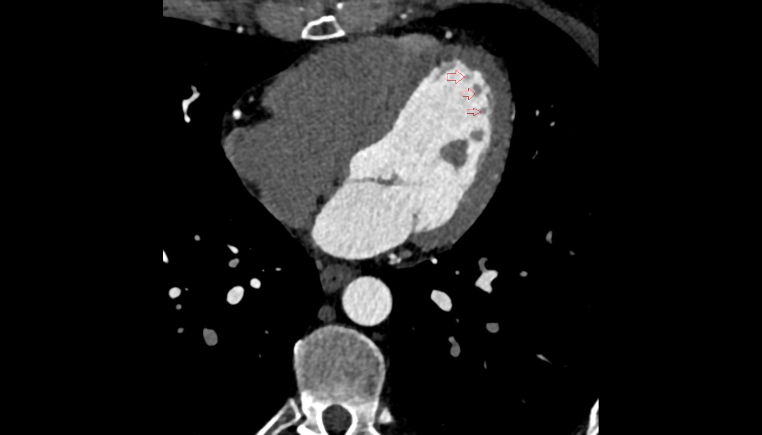 Trabeculae carneae of left ventricle CT axial image -img-00000-00000