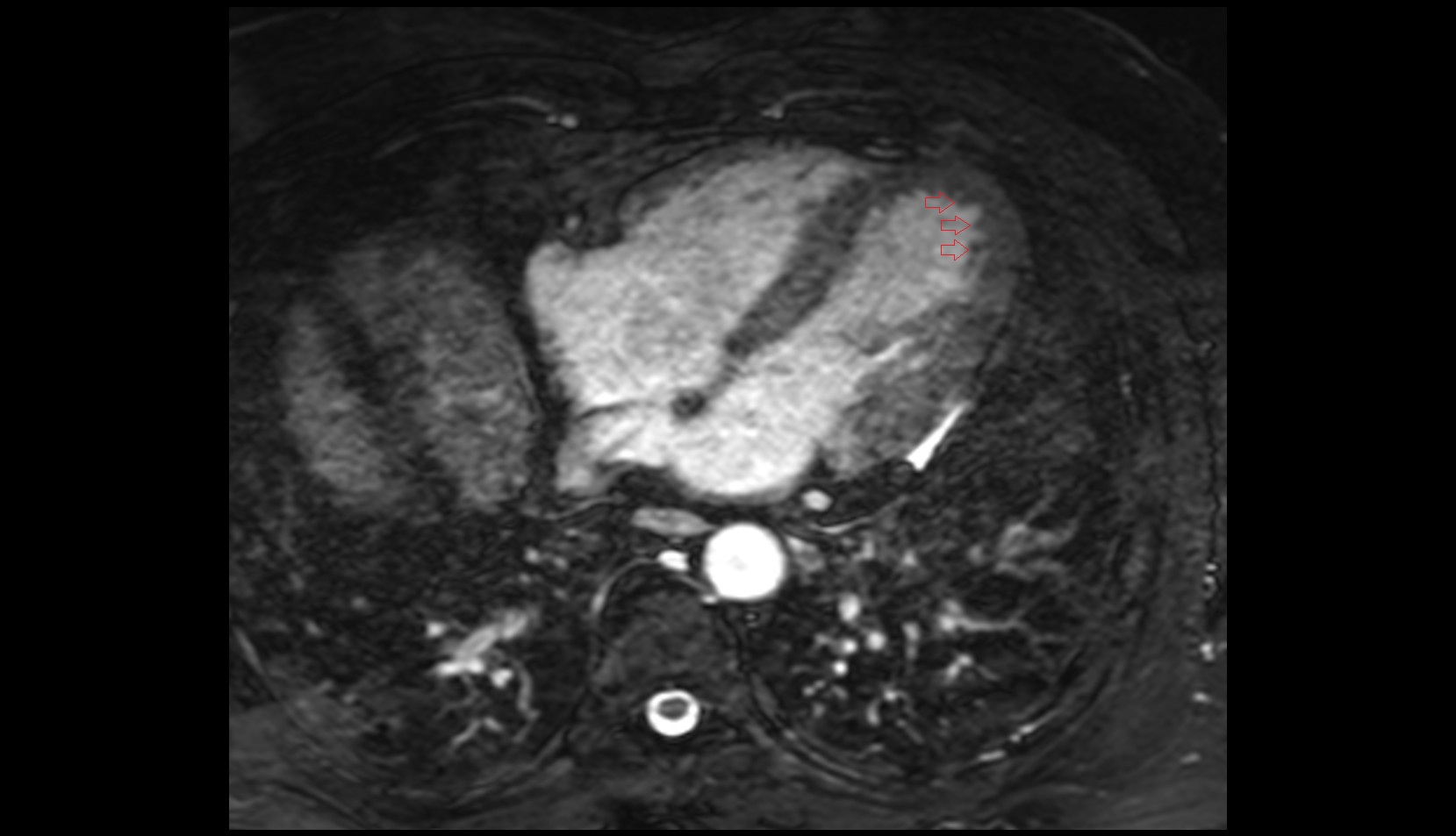 Trabeculae carneae of left ventricle mri image