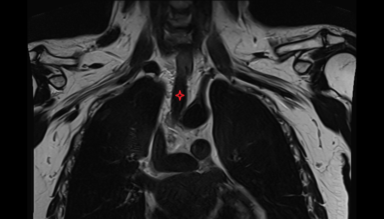 Trachea MRI coronal  image -img-00000-00000