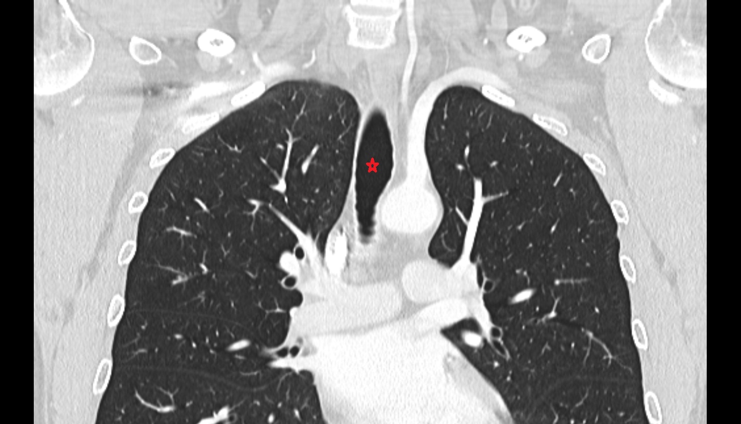 Trachea chest coronal  ct image -img-00000-00000