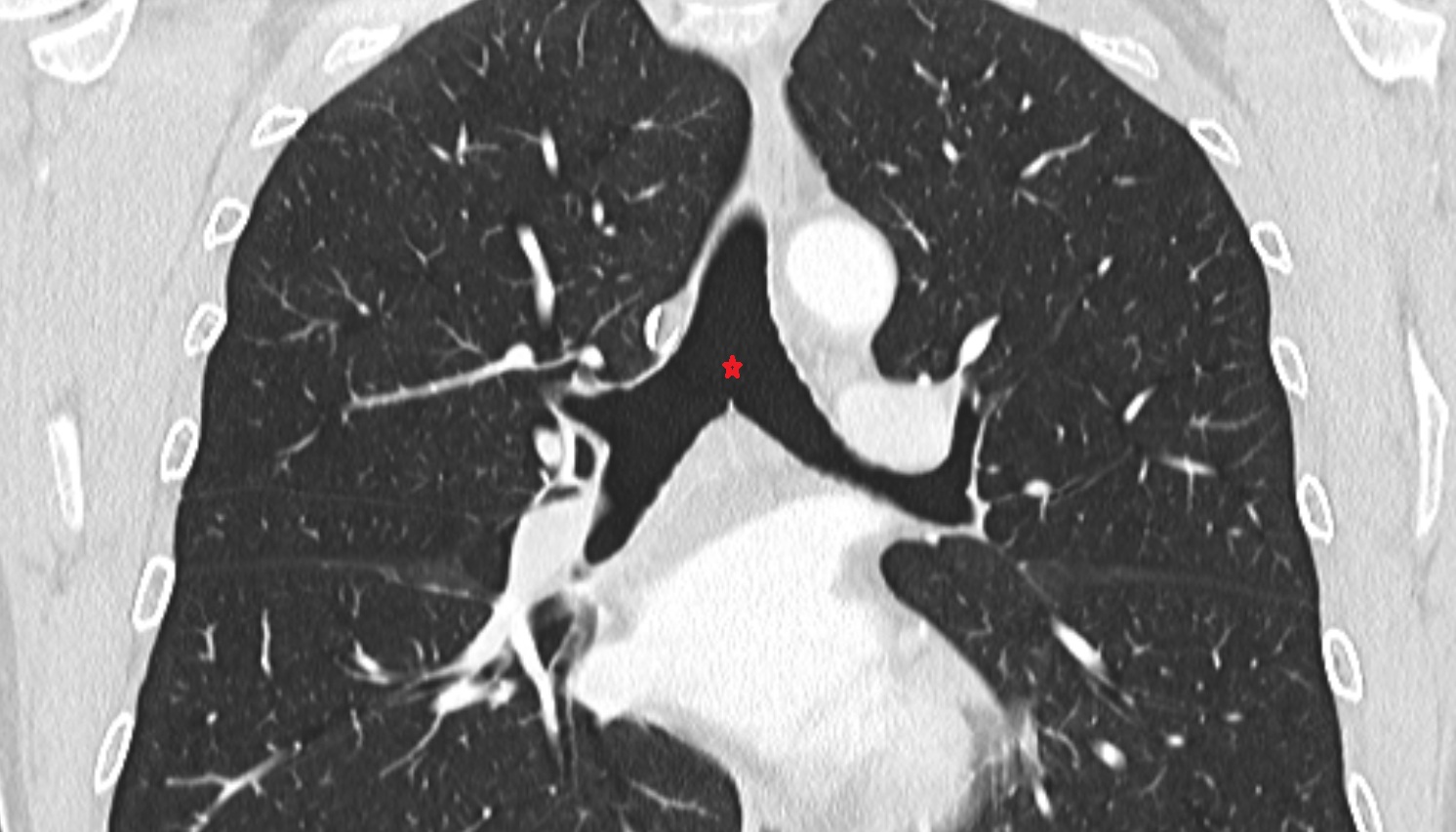 Tracheal bifurcation CT CORONAL image -img-00000-00000