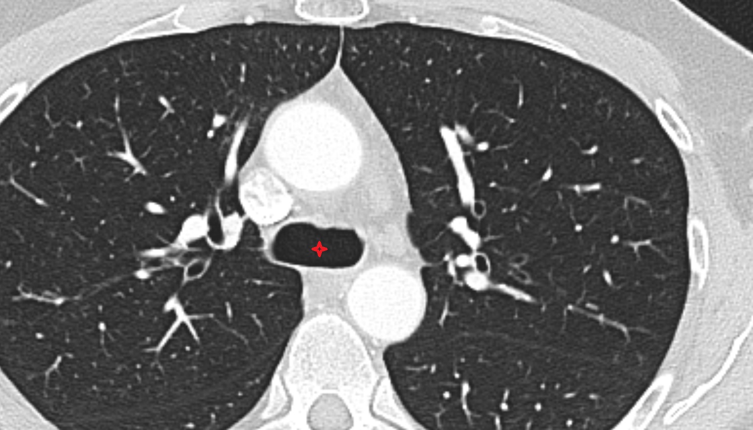 Tracheal bifurcation CT axial image -img-00000-00000